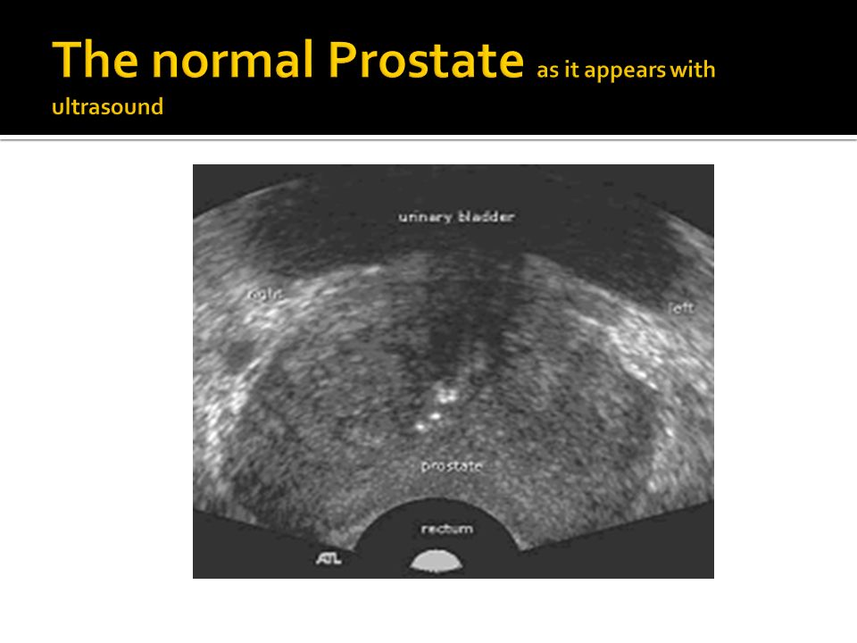 What is a prostate ultrasound